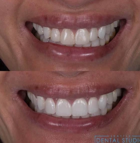 Patient smile result 1 — porcelain veneers by Dr. Dbouk