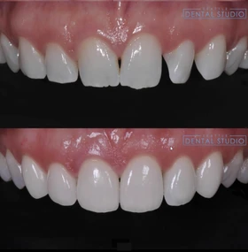 Patient smile result 2 — porcelain veneers by Dr. Dbouk