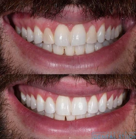 Patient smile result 3 — porcelain veneers by Dr. Dbouk