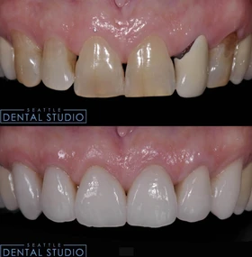 Patient smile result 4 — porcelain veneers by Dr. Dbouk