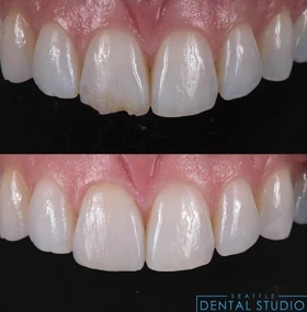 Patient smile result 5 — porcelain veneers by Dr. Dbouk