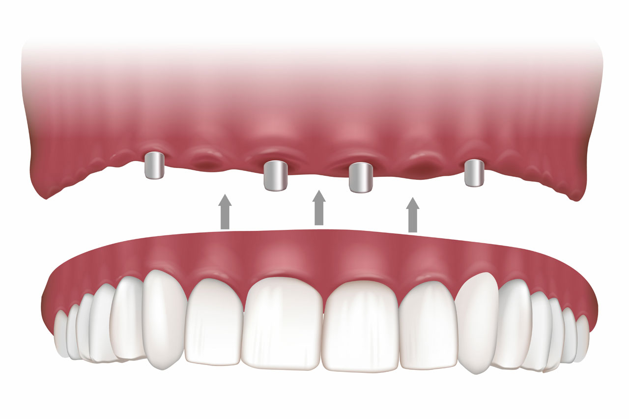 Maxillary Implant