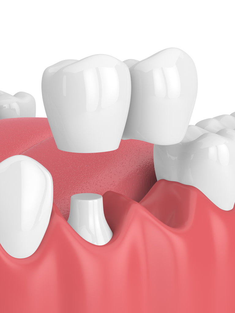 3d render of jaw with dental cantilever bridge over white background